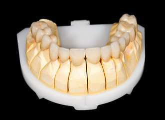 Dental ceramic bridge