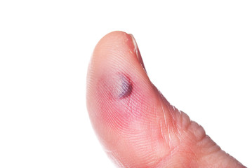 The bruise on finger