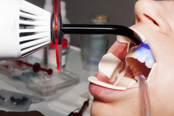 Dental hygiene and beauty procedures in the dental office,  dentist performs teeth whitening treatment, close up view
