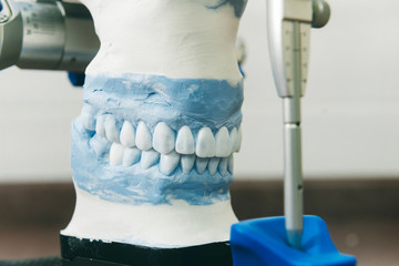 plaster cast of teeth with removable partial denture; showcasing