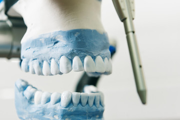 plaster cast of teeth with removable partial denture; showcasing