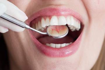 Fototapeta premium Healthy teeth and dental mirror closeup