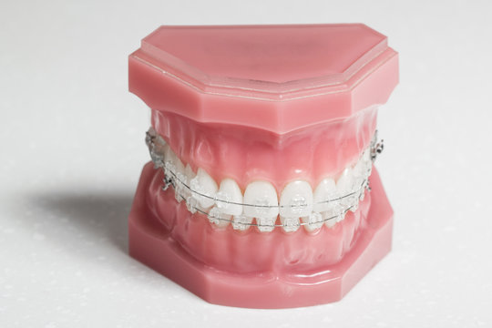 Clear braces - invisible brackets for teeth straightening