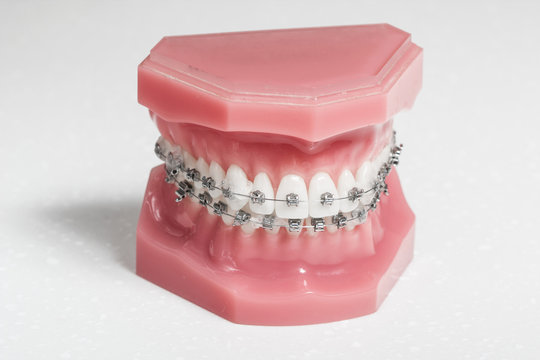 Metal Brackets - Tooth Aligners On A Model Jaw, White Background