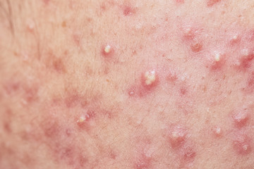 Acne on facial skin,Dermatological disease acne