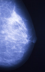 Xray of breast with tumor