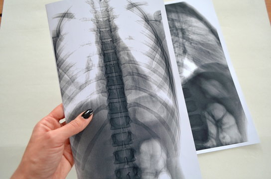 Рентген человеческого позвоночника - заключение врача, медецина