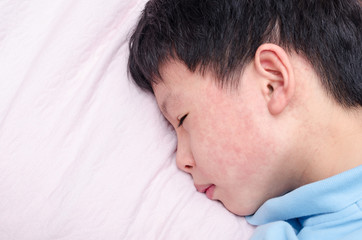 Young asian child face with rash lying on bed - obrazy, fototapety, plakaty