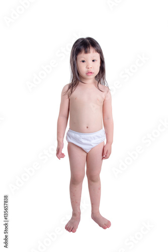 Little Asian Girl With Sore And Scar At Legs Arms And Face Little Asian Girl With Sore And Scar At Legs Arms And Face