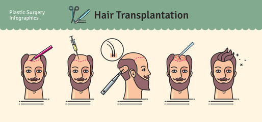 Vector Illustrated set with hair transplant surgery - obrazy, fototapety, plakaty