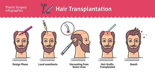 Vector Illustrated set with hair transplant surgery