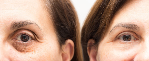 Trattamento cosmetico ringiovanente