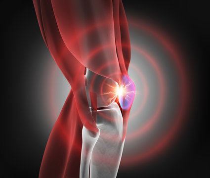 Meniskus - Schmerz im Knie 2