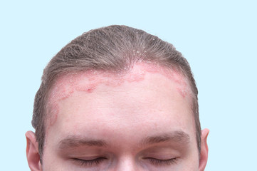 Red psoraitic spot on hairline. Dermatological disease, stress, seborrhea, dermatitis, appearance, eczema concept. Close up view of Psoriasis Vulgaris exacerbation on man's forehead and scalp
