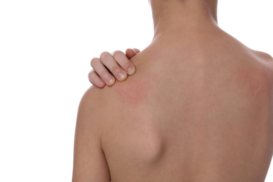 Child Scratching An Itch Isolated On White Background . Sensitive Skin, Allergic Reaction, Irritation