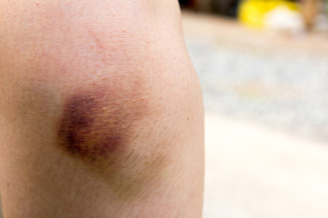 Brown bruise on woman knee background