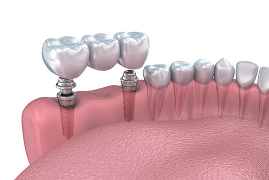 Lower teeth and dental implant transparent render isolated on white . 3D illustration