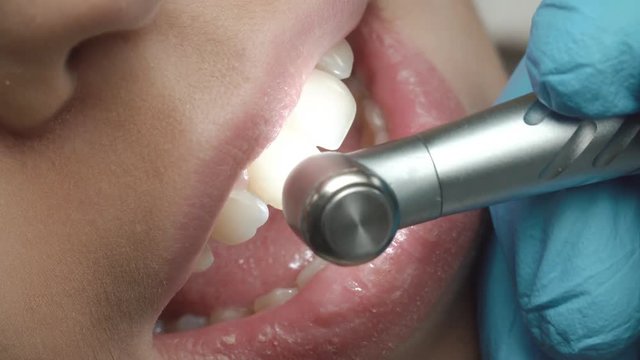 Professional dental cleaning. The patient at the dentist. Wide open mouth of girl.