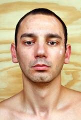 Young man with chronic infected candida albicans
