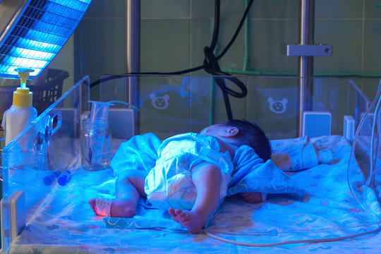 Newborn baby with hyperbilirubinemia under blue UV light for phototheraphy
