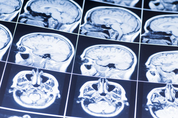 MRI of the brain. snapshot