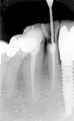Root treatment and implant view