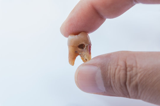 Tooth decay in hand