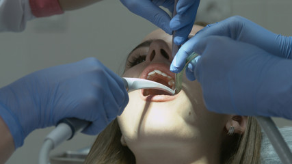 Medical dentist procedure of teeth polishing with cleaning from dental deposit and odontolith