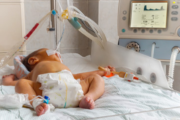 Newborn baby with hyperbilirubinemia on breathing machine with pulse oximeter sensor and peripheral intravenous catheter in neonatal intensive care unit