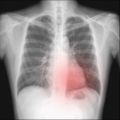 pneumothorax seen in chest radiography which want to intercostra