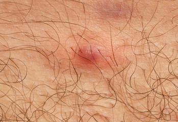 inflamed acne on the skin