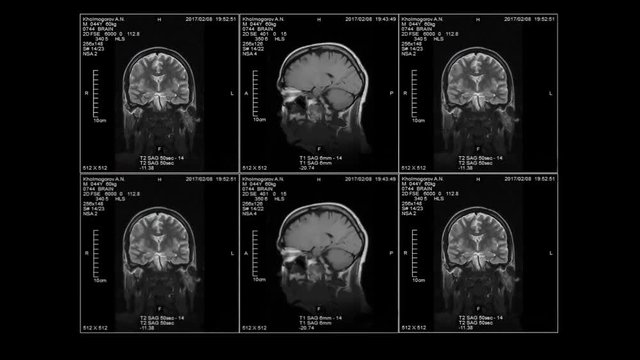 MRI of the brain in three dimensions, video loop, alpha-channel