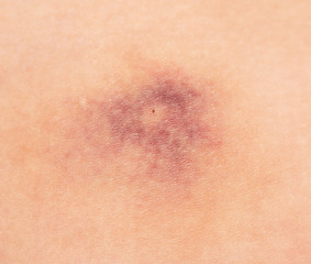 a bruise on the skin