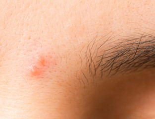 Fototapeta premium acne on the skin