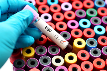  Epstein-Barr virus (EBV) positive