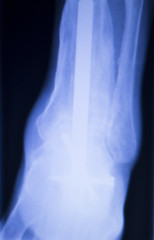Xray foot heel ankle scan