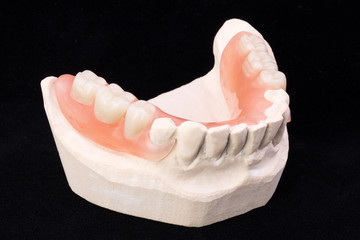 Denture, lower jaw