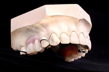 Denture, upper jaw © Aleksandrs Gorins