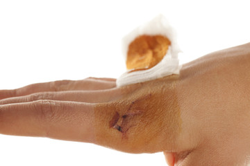 female injured hand with a lifted bandage