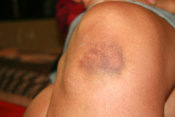 Fototapeta premium The bruise on his knee. The bruise on his leg.