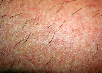 Regrown hair on the skin after shaving. Depilation. Reddened skin.