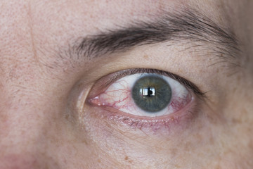 Close up of wide open red and irritated human eye