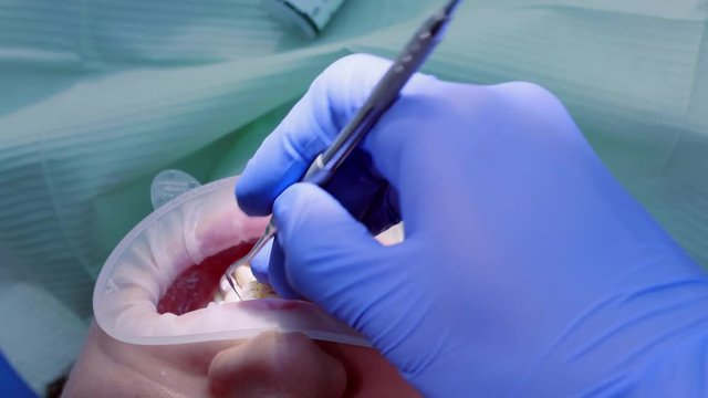 The doctor puts the thread to stop the bleeding between the tooth and gum of the patient. Close-up of the oral cavity in the process of dental procedures.