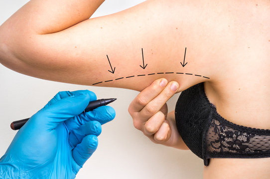 Plastic surgery doctor draw line on patient arm