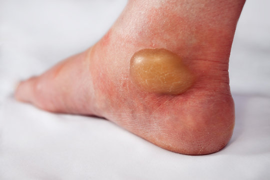 Burned foot with large blister