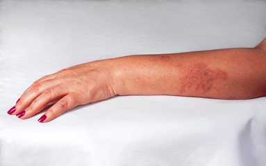Fototapeta premium Redness from burn on woman hand