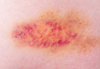 Closeup on a Bruise