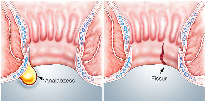 Anal-Abzess und Fissur