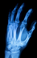 Hand fingers inury Xray scan