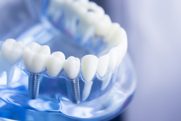 Dental teeth dentistry model - obrazy, fototapety, plakaty
